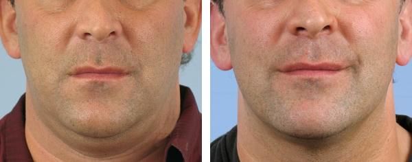 Thermage behandling: Oppstramming av hud ansikt/hals/kropp (Oslo, Bergen, Stavanger)
